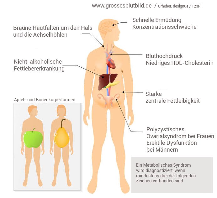 Metabolisches Syndrom