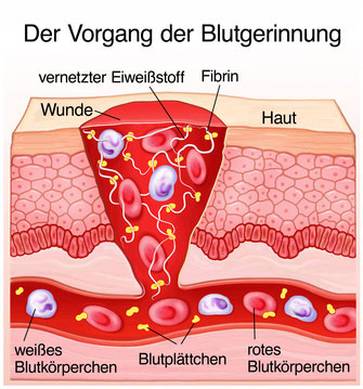 blutgerinnsel bei jungen erwachsenen