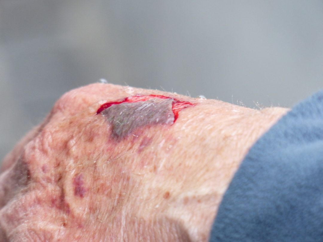 Haut-Blutungen in einer Wunde